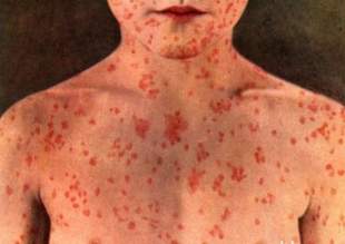 В Одессе значительно снизилась заболеваемость корью, морская вода соответствует нормам