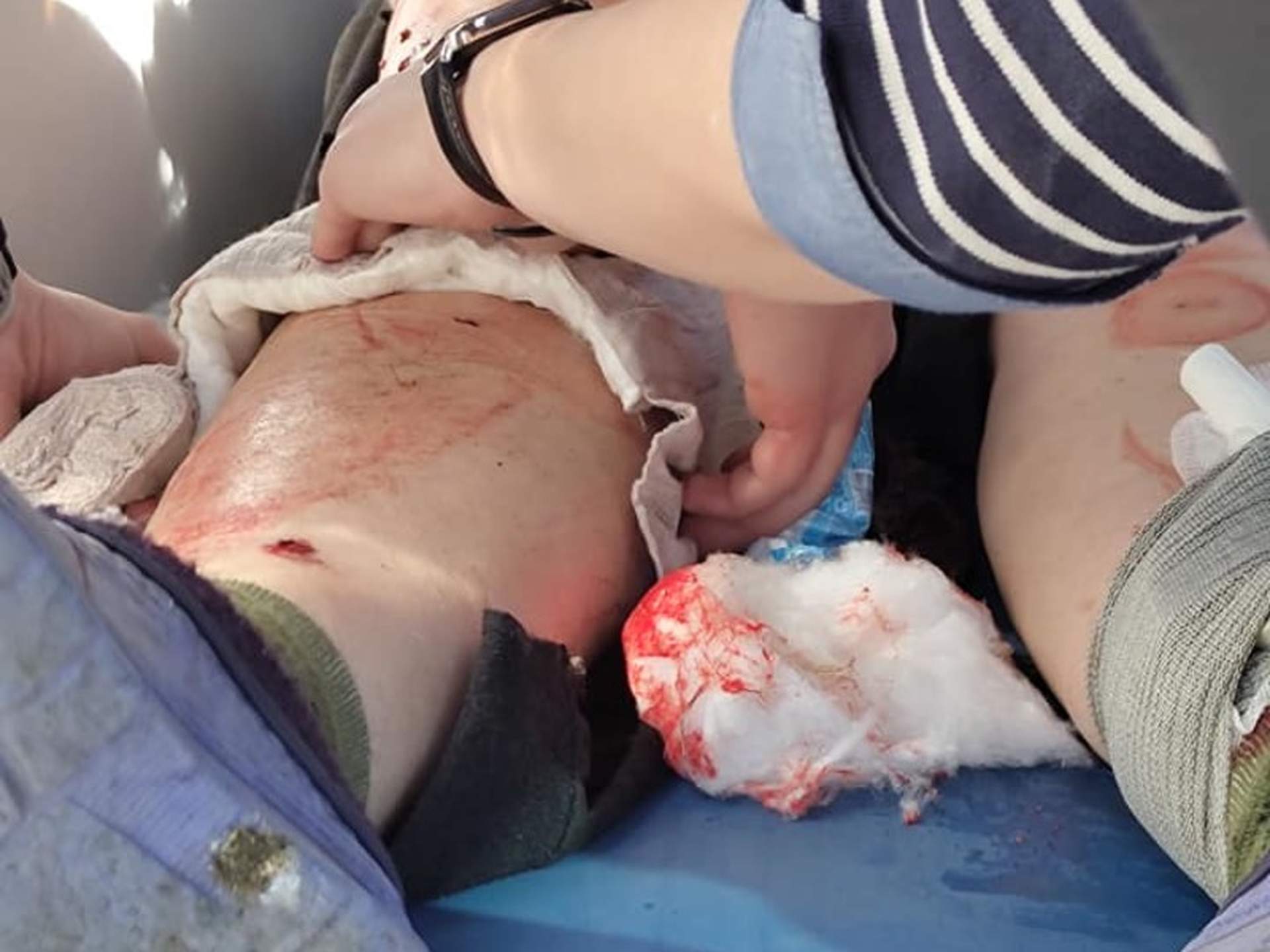 Одеські волонтери врятували жительку Миколаївщини, біля якої здетонував снаряд