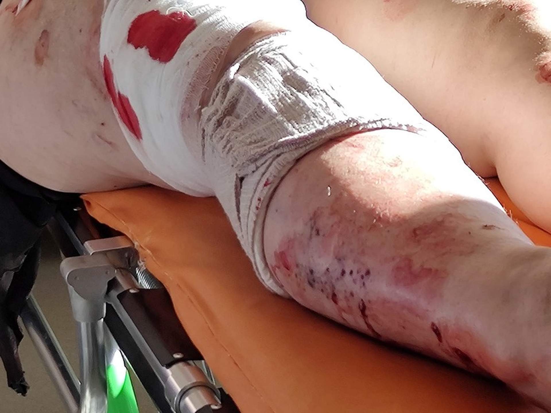 Одеські волонтери врятували жительку Миколаївщини, біля якої здетонував снаряд